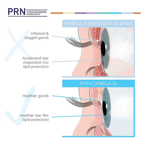 Illustration depicts eye cross-sections. Top: Omega-3 deficient glands with inflammation and quicker tear evaporation. Bottom: Healthier glands and improved tear film enhanced by PRN Dry Eye Omega Benefits® Liquid, featuring Re-esterified Triglyceride Fish Oil, for better Dry Eye Relief from PRN - Physician Recommended Nutriceuticals.