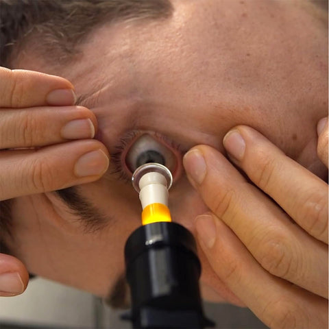 Using the S5 Mini Inserter from Augmented Vision Labs, a person holds their eyelid open and guides scleral lenses precisely into place, assisted by a flashlight-like device. Free video training is included.