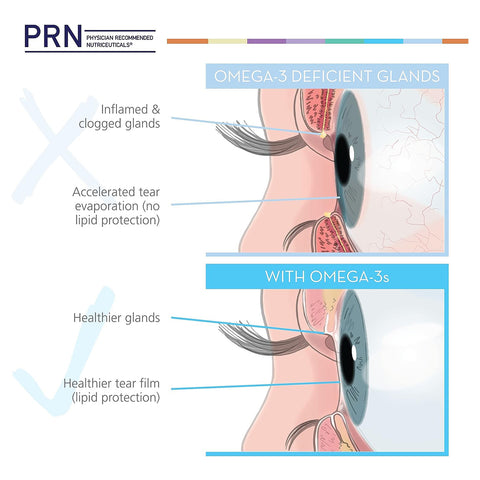 An illustration contrasts omega-3 deficient eyes with healthy ones. The top shows inflamed, clogged glands and rapid tear evaporation, while the bottom displays healthier glands and a tear film boosted by PRN DE3 Dry Eye Omega Benefits® for protection.