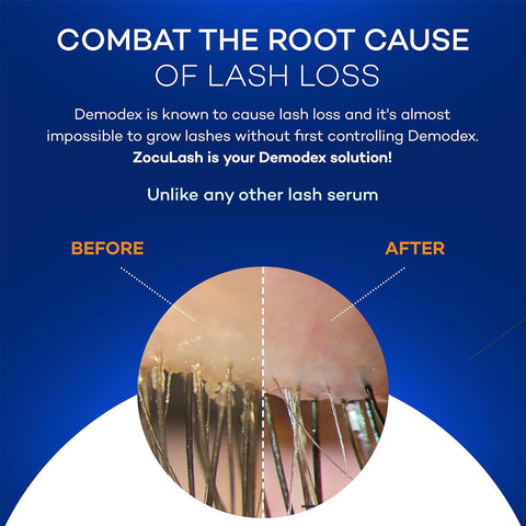 A promotional image for Zoculars ZocuLash Eyelash Enhancing Serum (2.5mL) showcases improved eyelash health before and after use, emphasizing the serums ability to combat lash loss and control Demodex with its Pro-Growth Tripeptide Lash Complex, against a blue background with white text.